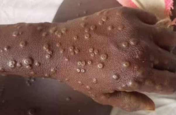 Laboratory research and Lassa fever diagnostics
